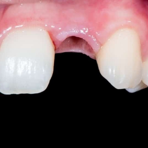 Avulsão (Perda dos Dentes)